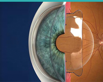 "chirurgie réfractive : limplant precristallinien"
