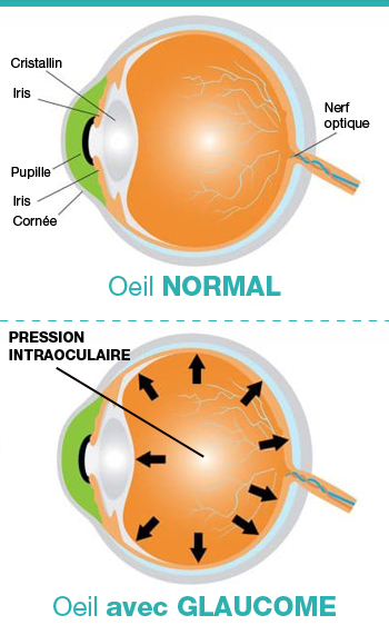 "traitement glaucome: pression intra oculaire"