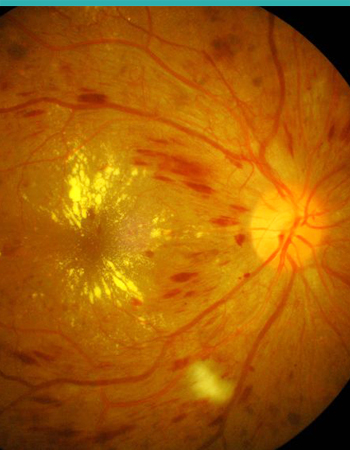 "traitement de la rétinopathie diabétique : oeil atteint de rétinopathie diabétique"